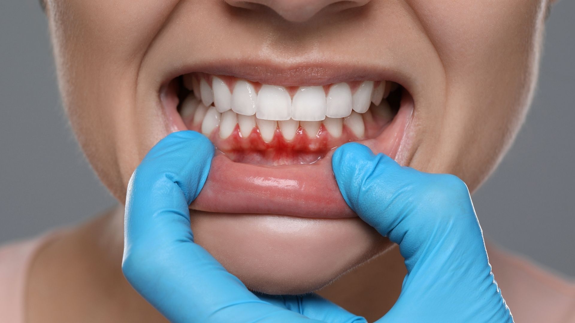 Gums Treatment in Vashi Navi Mumbai