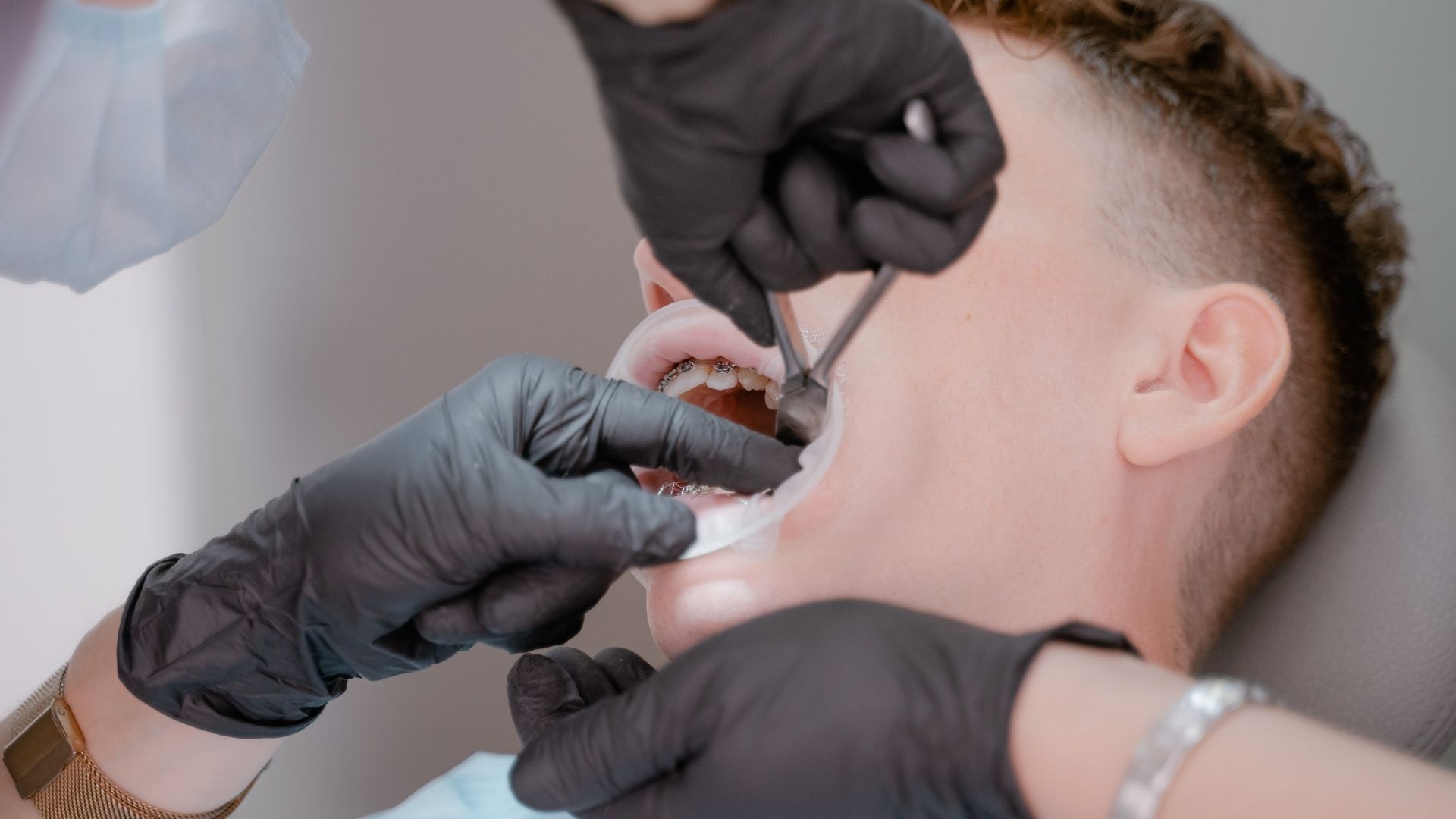 Wisdom Teeth Removal in Vashi Navi Mumbai