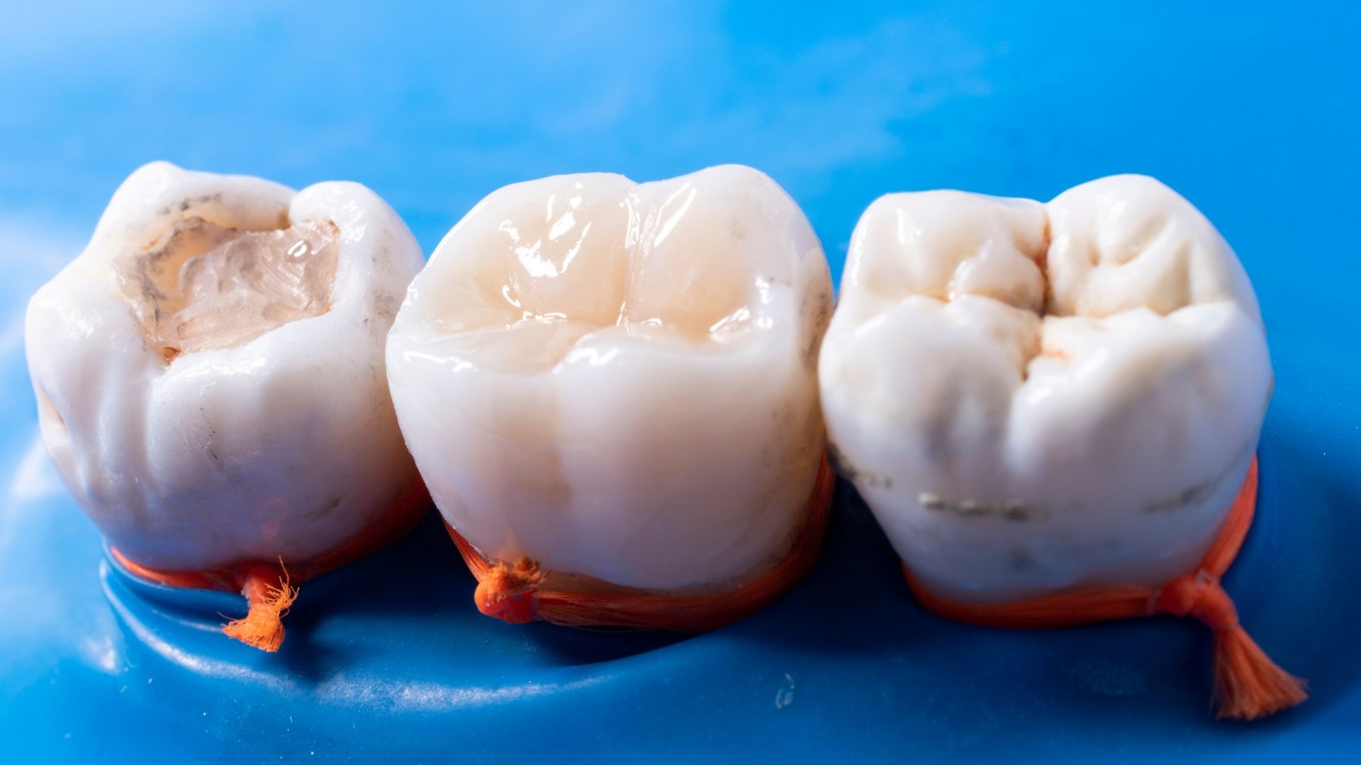 Dental Fillings in Vashi Navi Mumbai